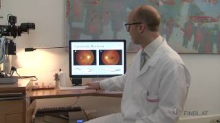 Epiretinale Membran  Macular Pucker Prof Findl Wien [upl. by Germaine]