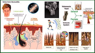 Seborrheic Dermatitis and Its Approach explained by Dr Makkar from Homeopathic website Askdrmakkar [upl. by Yhcir]