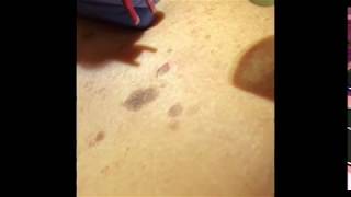 Treatment of Seborrheic Keratosis [upl. by Novets701]