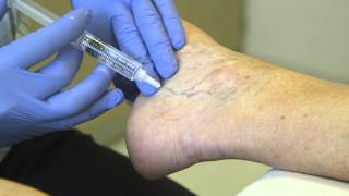 Spider Vein Treatment  Sclero Therapy [upl. by Ahsimot]