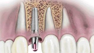 Duelen los Implantes Dentales [upl. by Aurelie]