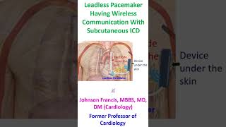 Leadless pacemaker having wireless communication with subcutaneous ICD [upl. by Susejedesoj]