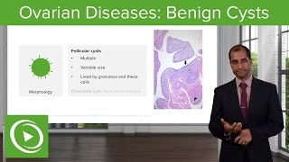 Ovarian Diseases Benign Cysts – Pathology  Lecturio [upl. by Ayeki]