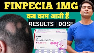 finpecia results before and after  finpecia 1mg uses  finpecia tablet [upl. by Kcin296]