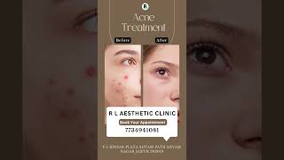 Acne Treatment Before and After rlaestheticclinic acnetreatment skincare [upl. by Worden]