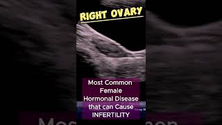 PCOS  Polycystic Ovaries  PCO  TVS Ultrasound [upl. by Banks]