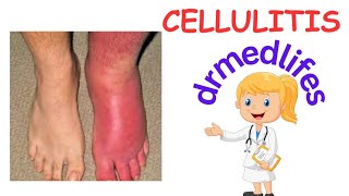 cellulitis  causes clinical features  investigation treatment [upl. by Akitan]