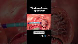 Watchman Implant Procedure 🫀 for afib related stroke [upl. by Nowujalo183]