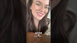 Stunning Results with SnapOn Veneers  Bil Veneer Review [upl. by Anaihs]