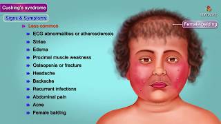 Cushing Syndrome  causes symptoms diagnosis treatment pathology Usmle step 1 videos [upl. by Liagabba]