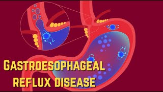 Gastroesophageal Reflux Disease GERD  CRASH Medical Review Series [upl. by Chak]