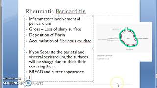 Pathology 436 e Rheumatic Fever Heart Mural Endocarditis Wall Cardiac PanCarditis PeriCarditis [upl. by Pesvoh]