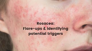 Rosacea flare ups and identifying potential triggers [upl. by Yrem]