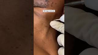 SKIN TAG REMOVAL [upl. by Ugo]