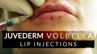 Lip Filler Juvederm Volbella Treatment [upl. by Mullins]