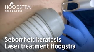 Seborrheic Keratosis  Laser treatment Hoogstra  22135 [upl. by Ultann]