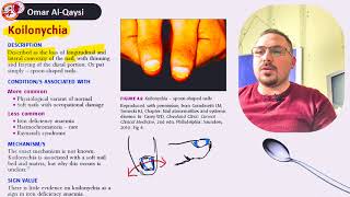 المعروف أيضا باسم الأظافر الملعقة│koilonychia [upl. by Egin]