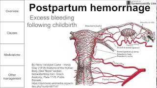 Postpartum hemorrhage [upl. by Hart660]