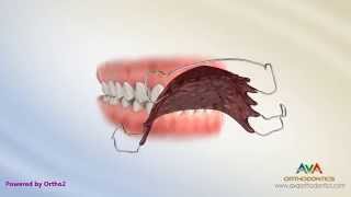 Orthodontic Retainers Hawley Clear and Permanent [upl. by Notle945]