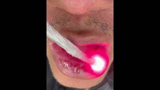 Laserterapia no tratamento de mucosite oral  ONCOLOGIA [upl. by Nerad]