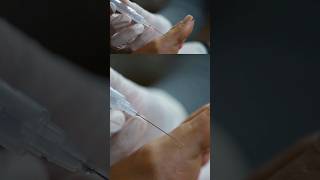 How to perform a local anaesthetic injection of the toe [upl. by Sualakcin]