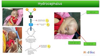 Hydrocephalus baby  Clinical features  Causes  Pathophysiology  Investigations  Treatment [upl. by Andonis877]