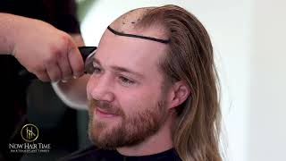 Hair Transplant Journey W I HunterClowdusVlogs [upl. by Haldis]