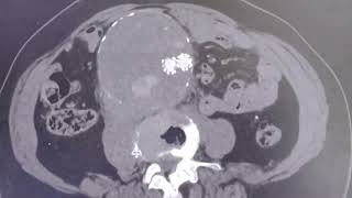 Aortic rupture after EVAR with endoleak [upl. by Aekin]