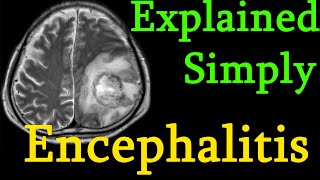 Encephalitis  brain inflammation  Symptoms causes prognosis Treatment explained simply [upl. by Anel]