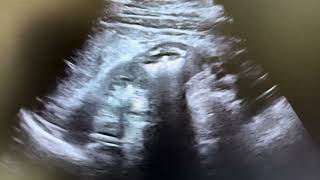 Ultrasound of nephrocalcinosis [upl. by Iramo]