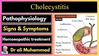 Cholecystitis amp homeopathy Dr Ali Muhammad [upl. by Warthman]