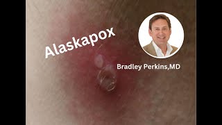 Alaskapox What do we know about this virus [upl. by Litman]