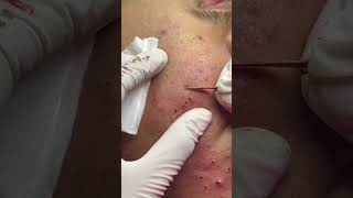 Best Pimple Popping 07 beautiful blackheads sacdepspa [upl. by Queenie]