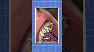 O segredo dos dentes de soldados 🦷 curiosidades fatos shorts radardascuriosidades [upl. by Eimerej]