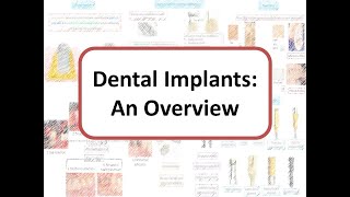 Implants An Overview Osseointegration Types of Bone One stage vs Two stage surgery [upl. by Tabina]