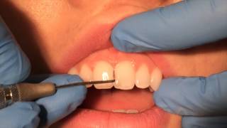 Periodontal Probing [upl. by Toblat118]