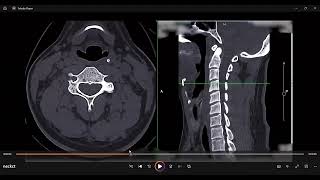 nect ct anatomy aryepiglottic foldscobra fangs analogy [upl. by Gabbi]