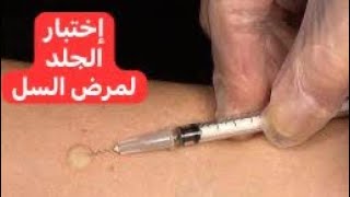 إختبار الجلد لمرض السل Tuberculin Skin Test [upl. by Latihs]