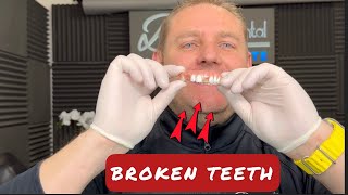 Broken ALLON4 DENTAL IMPLANT SOLUTIONS [upl. by Valle]