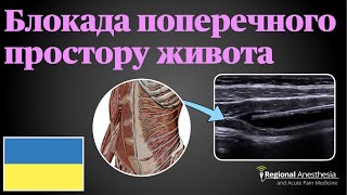 Блокада поперечного простору живота TAP блокада 🇺🇦 Transversus abdominis plane TAP Block [upl. by Wei]