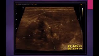 MEDULLARY THYROID CARCINOMA [upl. by Whitcomb]