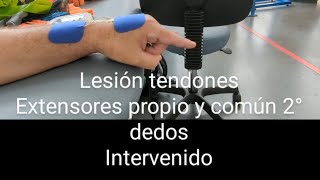 Lesión tendones extensor propio y común 2° dedo tratamiento [upl. by Ledniahs902]