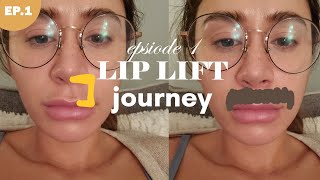 LIP LIFT SURGERY 💉 Episode 1  why I am getting a lip lift [upl. by Morvin234]