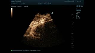 Hemangioma 33 CEUS [upl. by Bonaparte913]