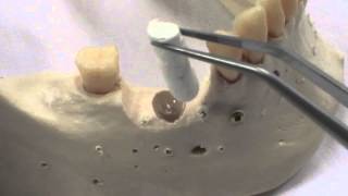 Osteogen Plug Bone Grafting Dental  Extraction Classes [upl. by Roehm]