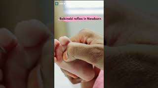 Babinski sign Babinski reflex in newborn baby [upl. by Nevada144]