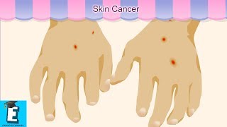 Skin Cancer Learn for Children and Kids  EDUKID Learning [upl. by Acilef]