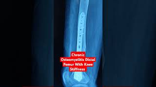 Chronic Osteomyelitis Distal Femur With Knee Stiffness Dr Sai Chandra [upl. by Myrtice690]