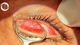 Chalazion surgery [upl. by Oecam]