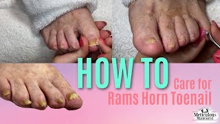 How to Pedicure Nail Care on Rams Horn Toenail [upl. by Eniamat]